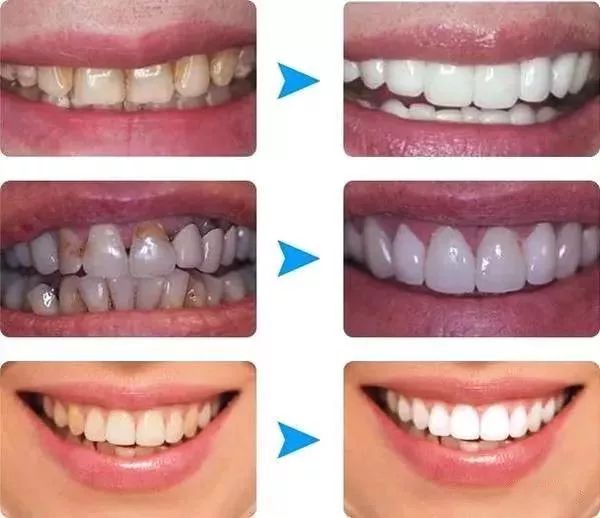 牙齒洗白要多少錢(qián)？全面解析牙齒美白費(fèi)用因素，牙齒美白費(fèi)用全解析，牙齒洗白需要多少錢(qián)？