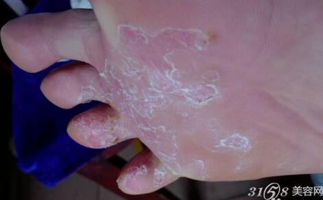 腳脫皮怎么辦？藥物治療推薦與護(hù)理建議，腳脫皮解決方法，藥物治療推薦及護(hù)理建議