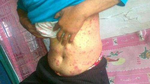 男生下面流膿，原因、應(yīng)對(duì)措施與健康提醒，男性私處流膿，原因、應(yīng)對(duì)與健康警示