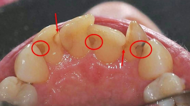 牙結石怎么去除小竅門，牙結石去除小妙招分享