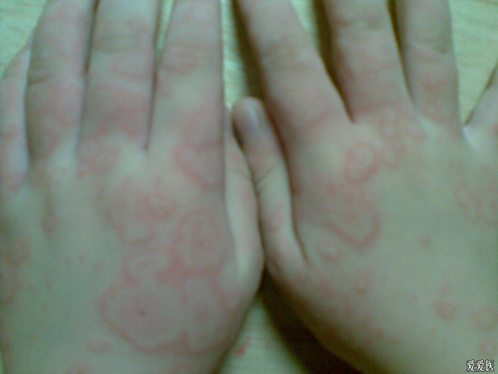 關于螨蟲過敏圖片與澳彩資料的查詢，來自94848.cσm的詳盡資源，螨蟲過敏圖片與澳彩資料查詢，詳盡資源來自94848.cσm