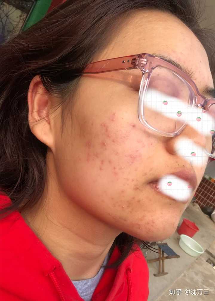 消除痤瘡留下的紅色痘印的有效方法，消除紅色痘印，痤瘡后的護膚秘訣