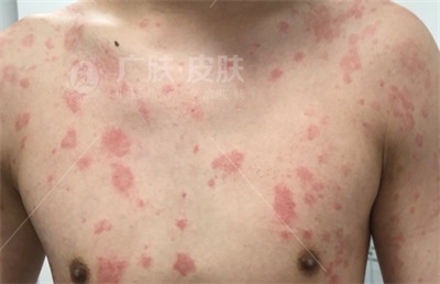 晚上發(fā)作的蕁麻疹名稱及其相關(guān)知識解析，夜間蕁麻疹發(fā)作解析，癥狀、原因與知識科普