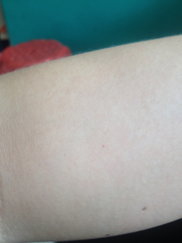 皮膚下有小紅點像滲血，原因、診斷與處理方法，皮膚小紅點疑似滲血，原因、診斷及處理方法全解析