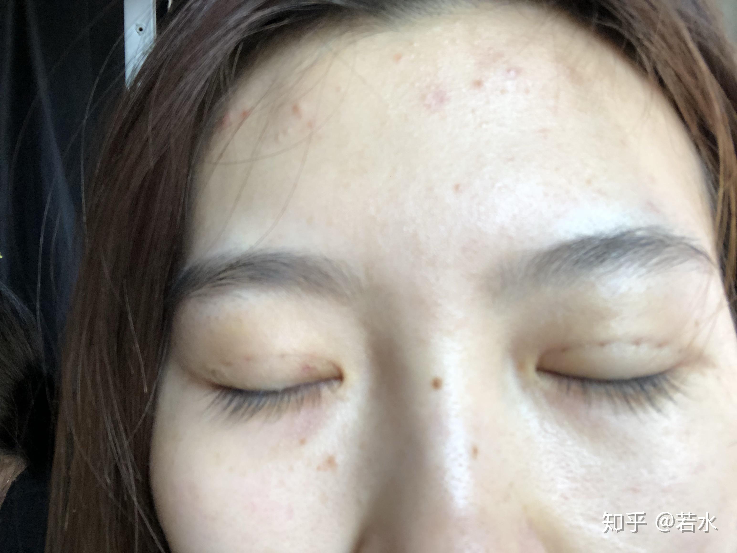 雙眼皮埋線手術效果持久性解析，持續(xù)時間與影響因素探討，雙眼皮埋線手術的持久性與影響因素深度解析