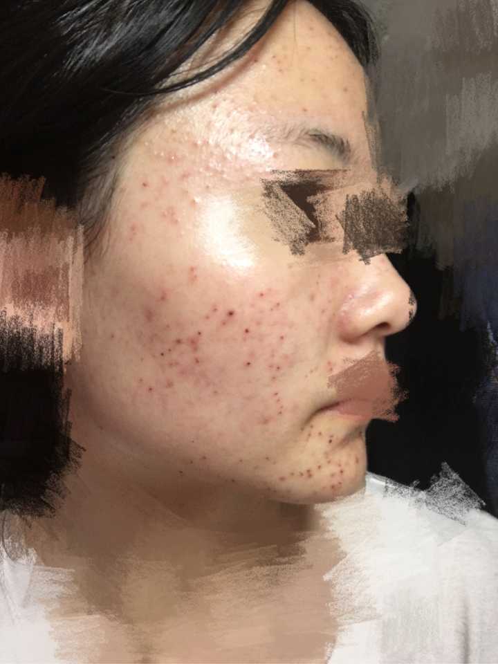 激光祛痘痘有效果嗎，深度解析與全面理解，激光祛痘效果深度解析與全面理解指南