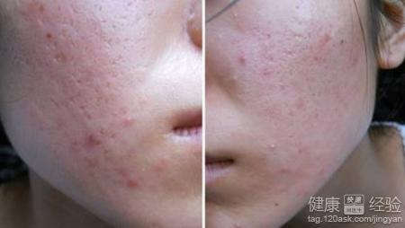 什么是痤瘡？一篇全面的SEO文章解析，全面解析，痤瘡的定義與防治——專業(yè)SEO文章解讀