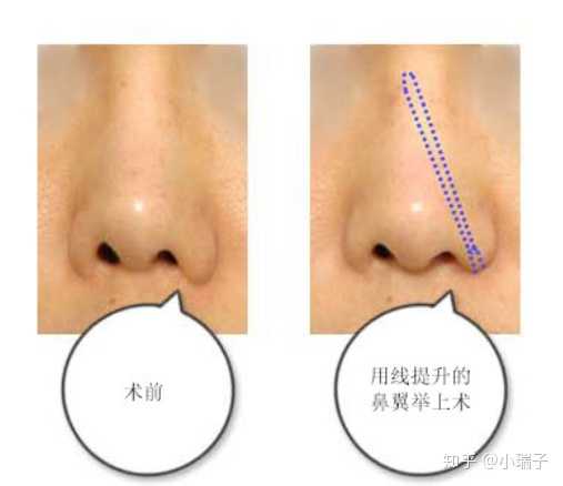 縮小鼻翼的方法，有效改善鼻翼過大的實(shí)用指南，縮小鼻翼的有效方法，實(shí)用指南助你改善鼻翼過大問題