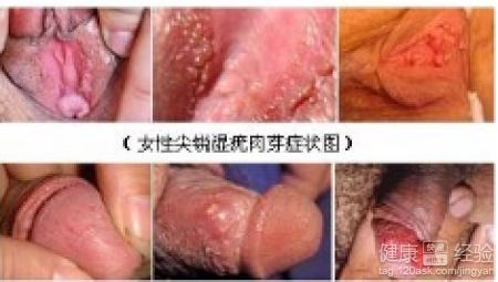 男性初期小疣體圖片，了解、識(shí)別與應(yīng)對(duì)，男性初期小疣體圖片詳解，識(shí)別、理解與應(yīng)對(duì)方法