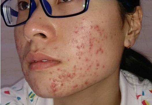 如何去除青春痘，男生的護(hù)膚指南，男生護(hù)膚指南，如何有效去除青春痘