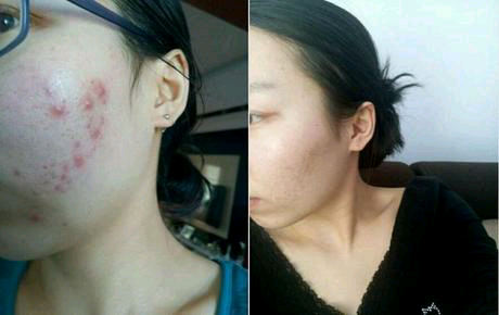 長青春痘怎么處理最好？全面解析最佳應(yīng)對策略，全面解析青春痘最佳應(yīng)對策略，最佳處理方法與建議