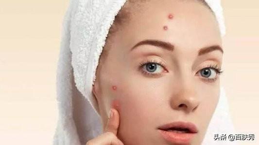 痤瘡是什么——深入了解痤瘡的成因、癥狀與治療方法，痤瘡解析，成因、癥狀及治療方法全面介紹