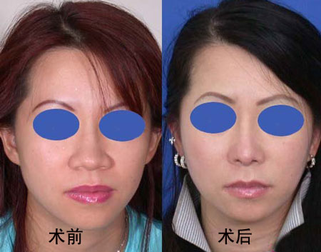 縮鼻翼手術(shù)風(fēng)險分析，風(fēng)險大嗎？，縮鼻翼手術(shù)風(fēng)險詳解，手術(shù)風(fēng)險是否大？